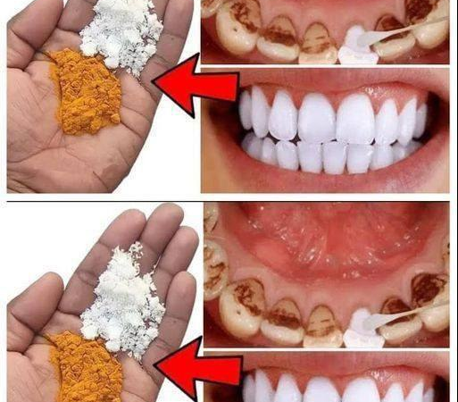 Natural Remedies with Cloves and Bay Leaves for a Brighter Smile…