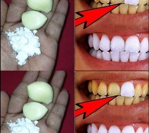 Garlic: A Surprising Ingredient for Making Teeth Whiter