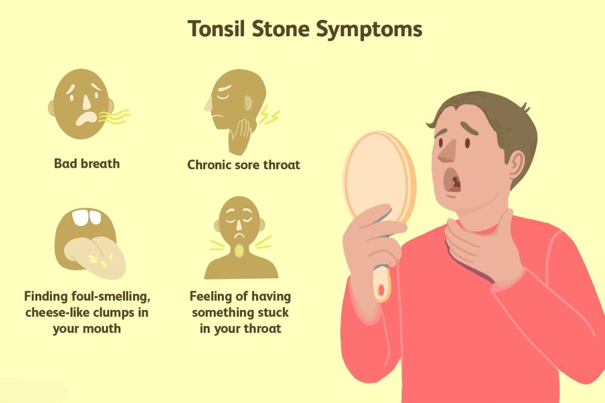 Common Symptoms of Tonsil Stones