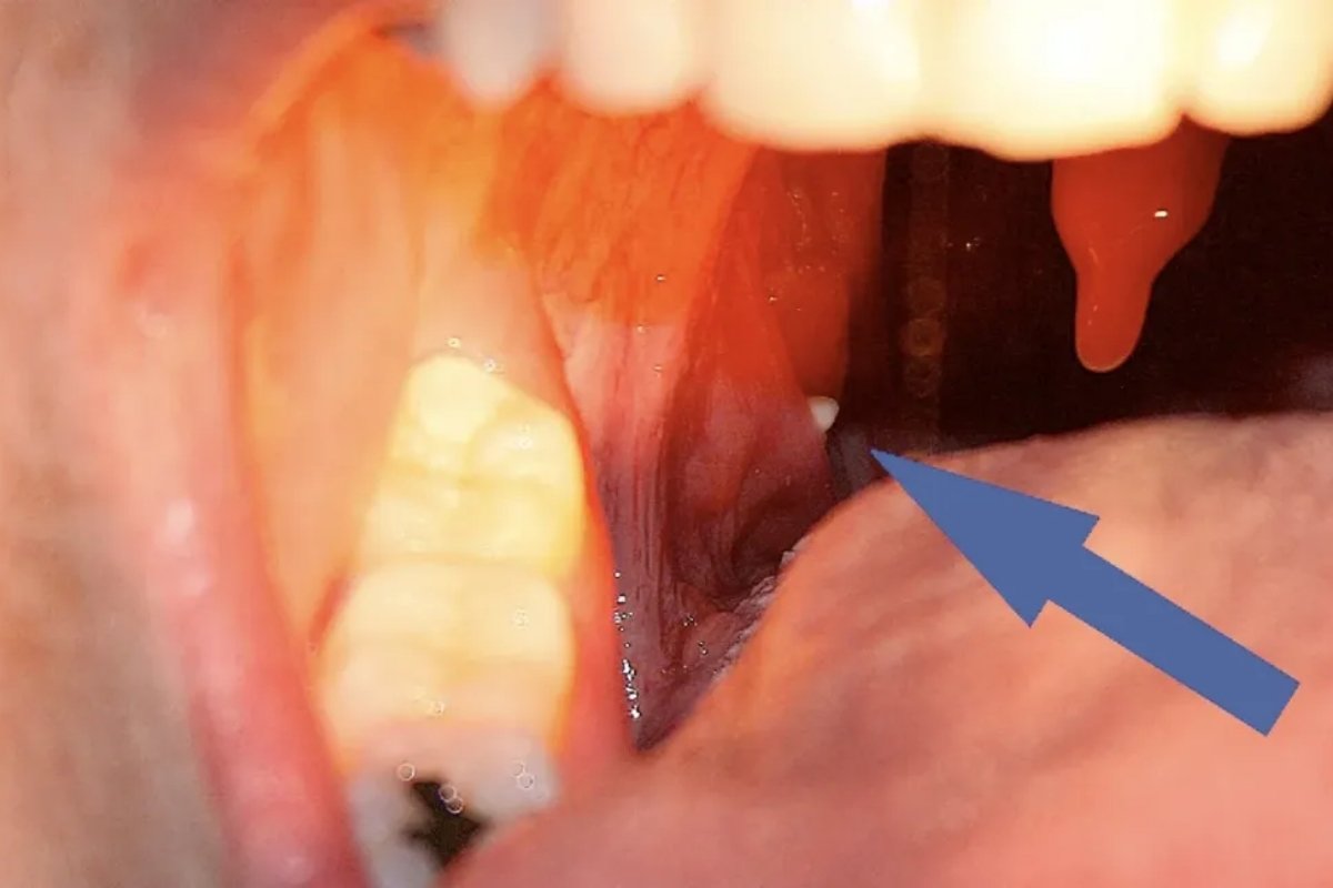 Diagnosing Tonsil Stones