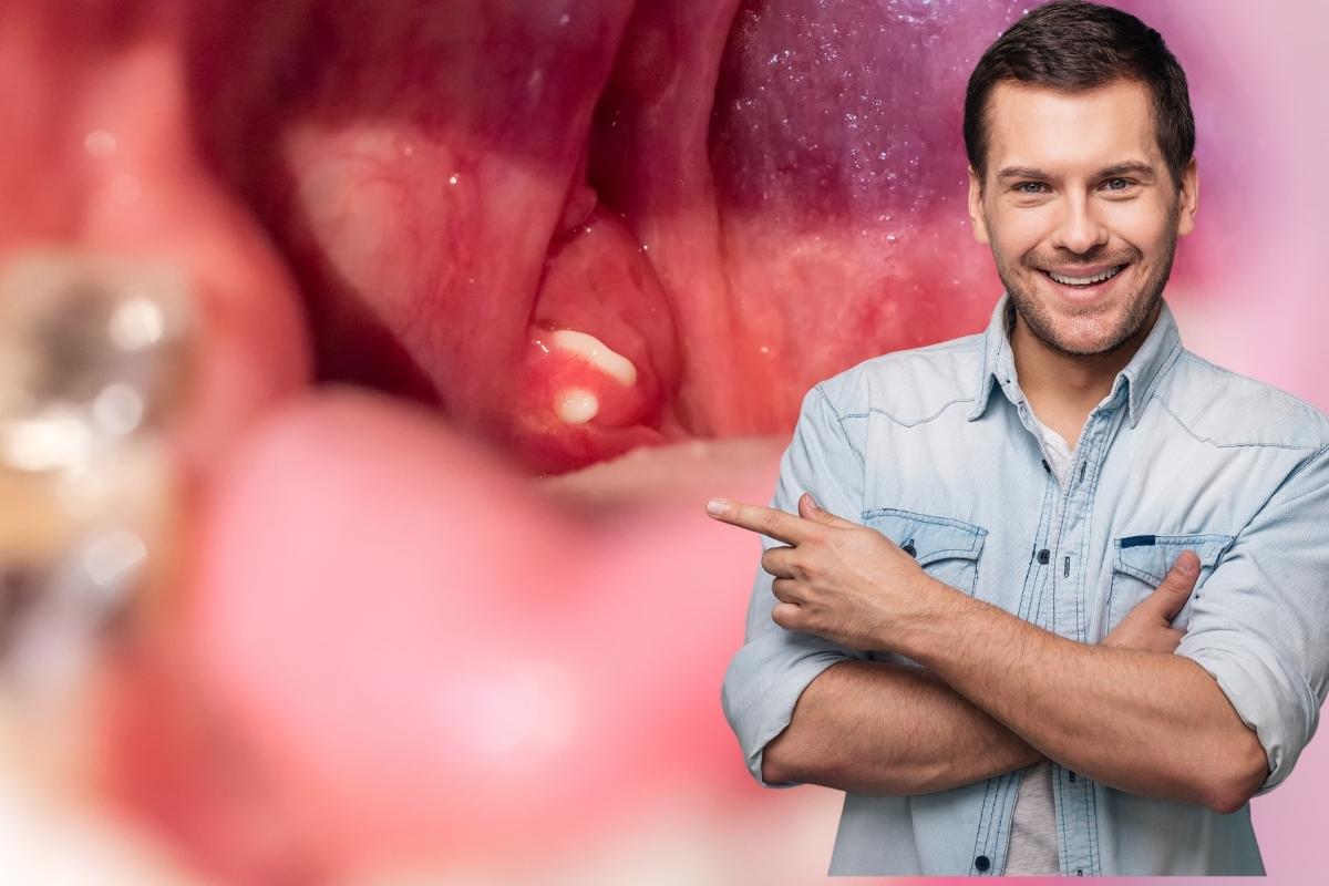 How to Prevent Tonsil Stones